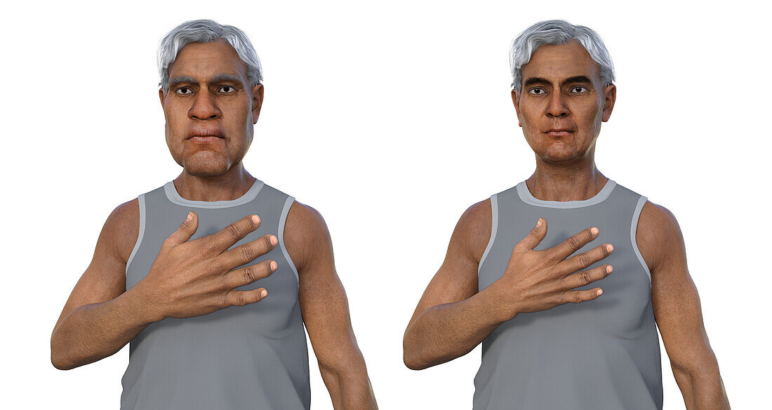 Man with and without acromegaly, illustration