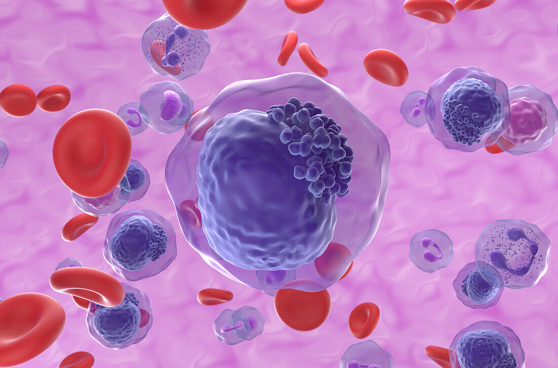 Acute myeloid leukemia, illustration