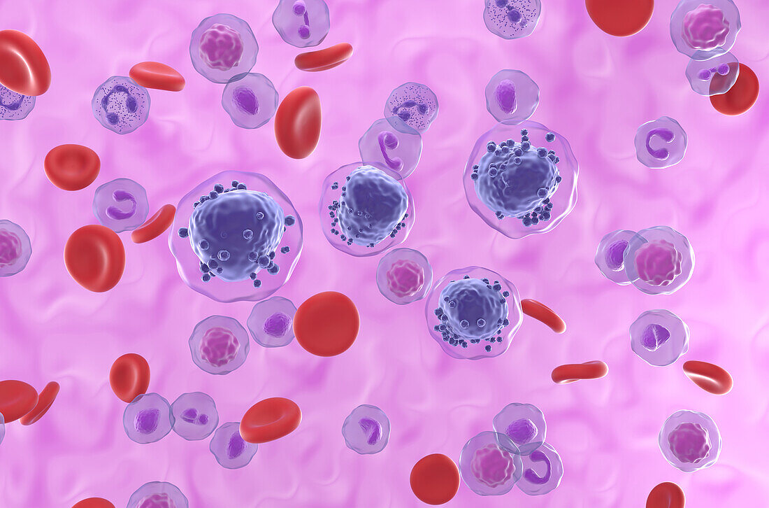 Acute myeloid leukemia, illustration