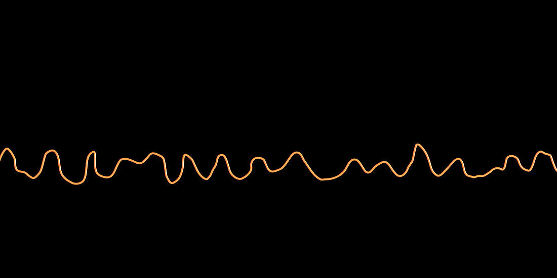 Ventricular fibrillation heartbeat rhythm, illustration