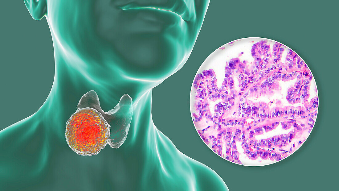 Thyroid cancer, illustration