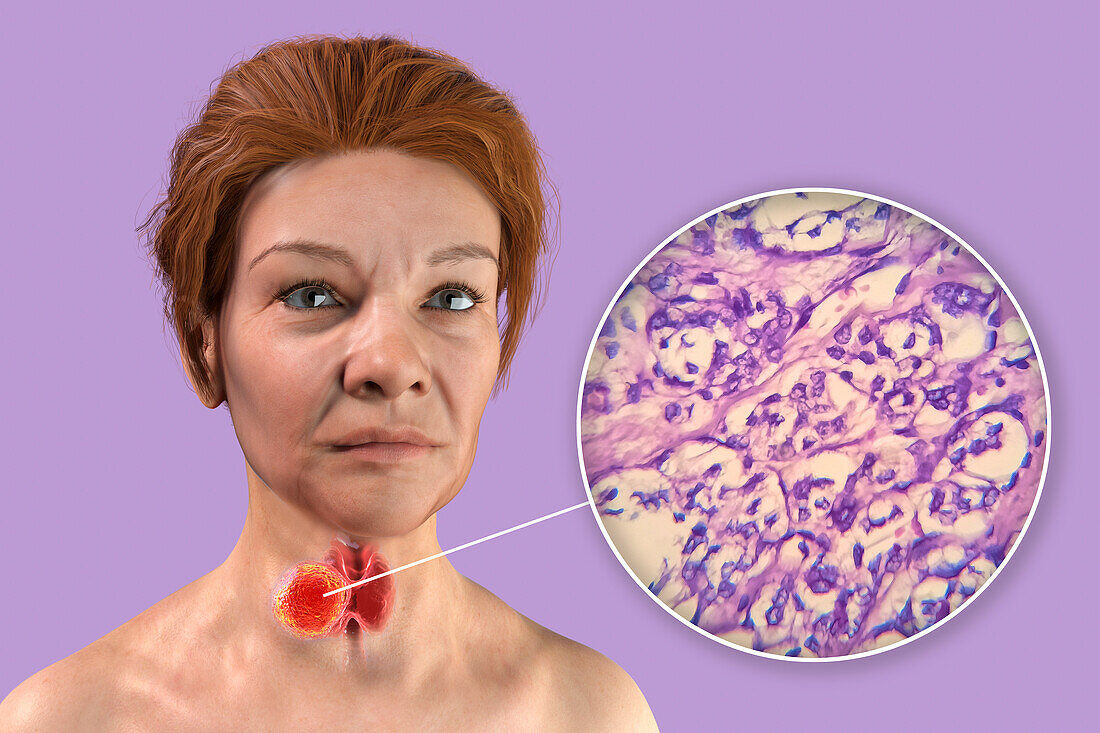 Woman with thyroid cancer, illustration