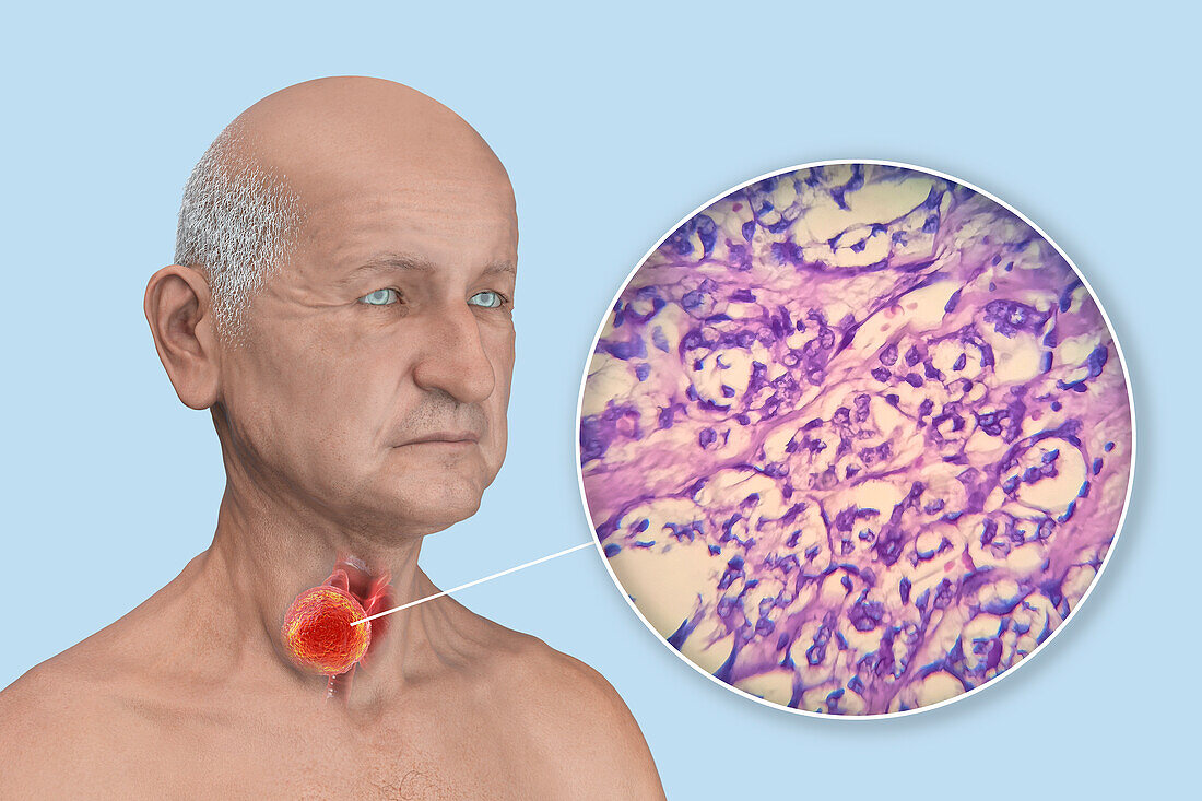 Man with thyroid cancer, illustration