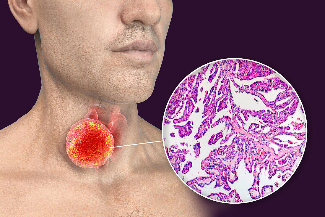 Man with thyroid cancer, illustration