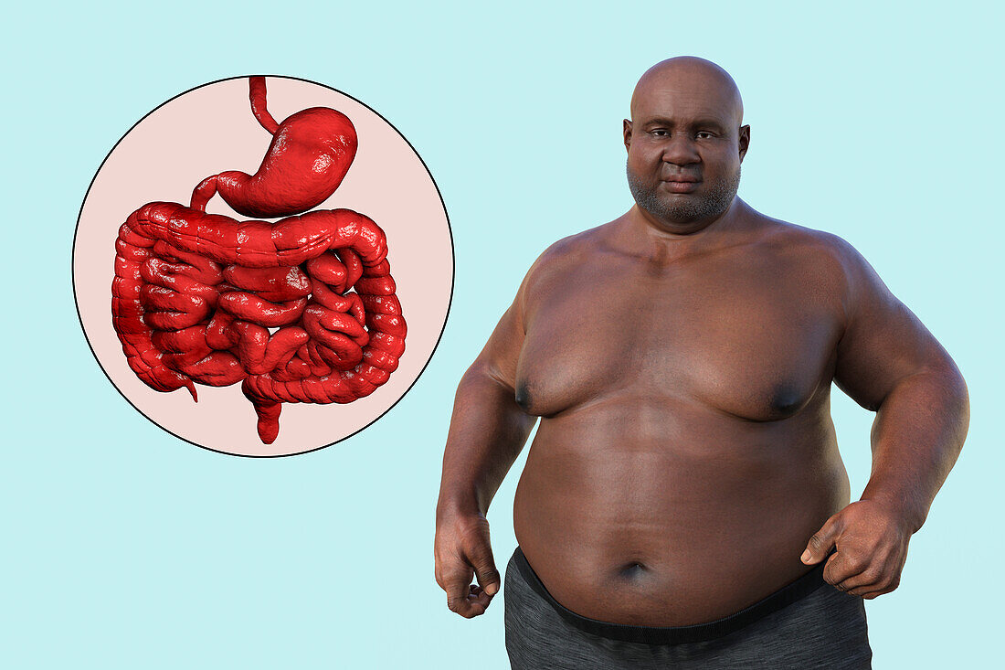 Obese man's digestive system, illustration