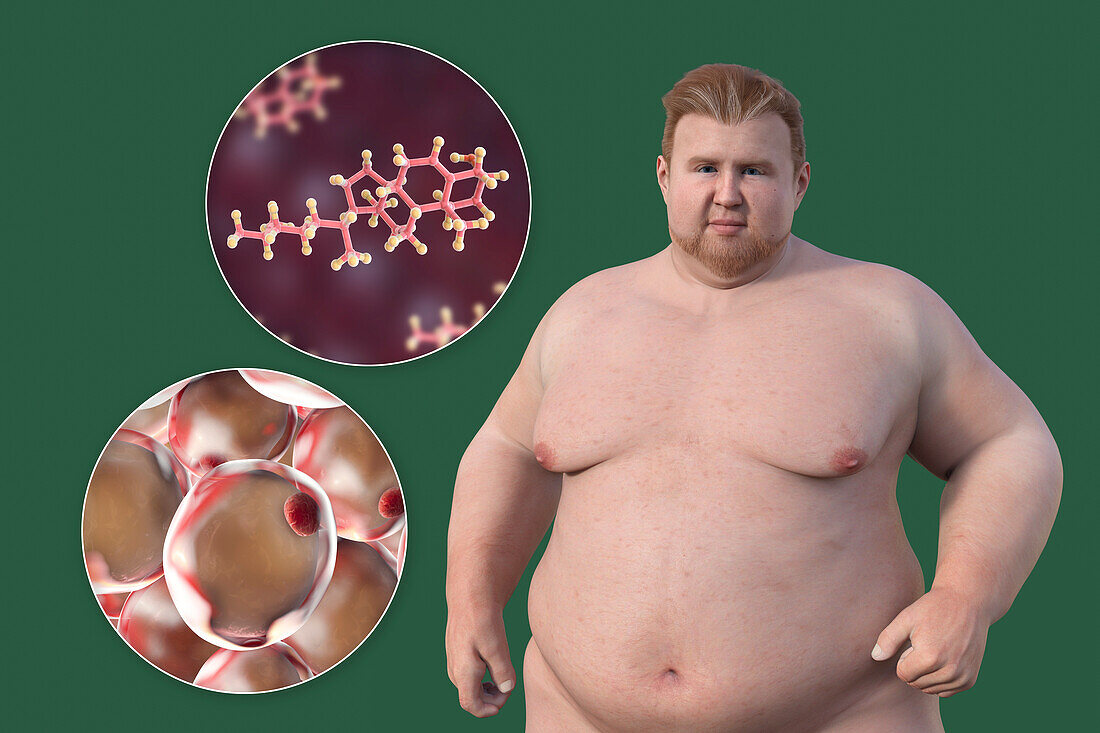 Overweight man with adipocytes and cholesterol, illustration
