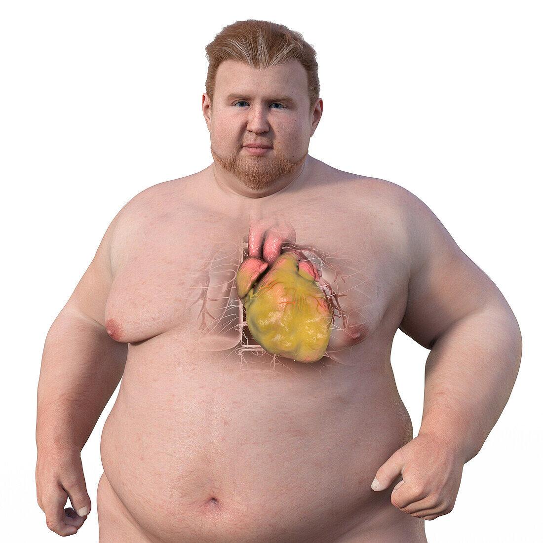 Overweight man with enlarged heart, illustration