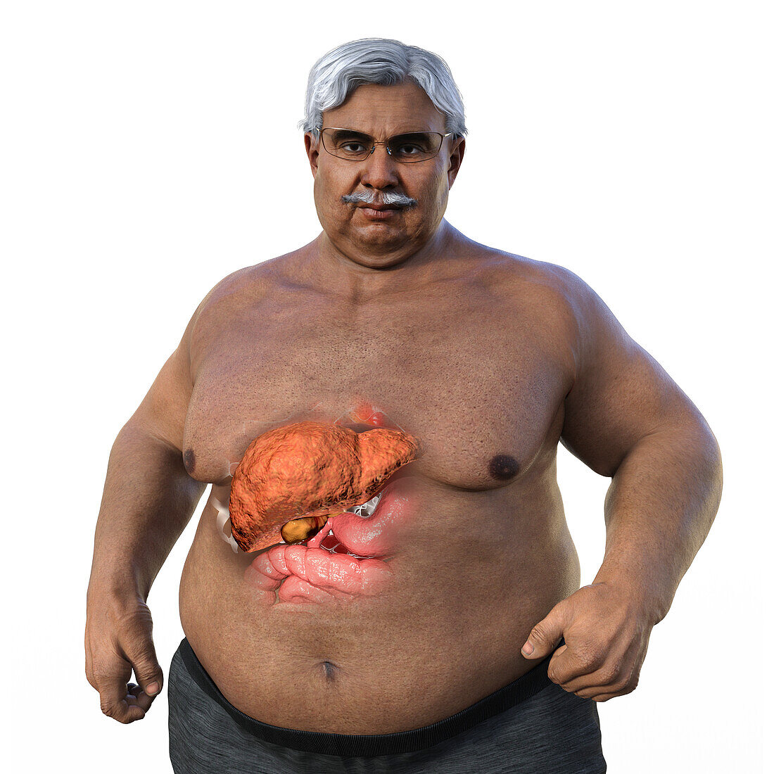 Overweight man with steatosis, illustration
