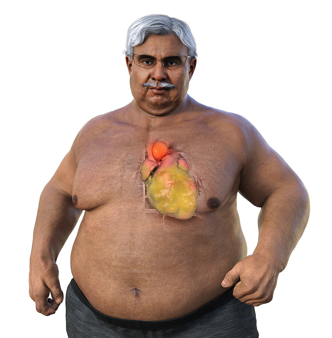 Obese man with ascending aortic aneurysm, illustration