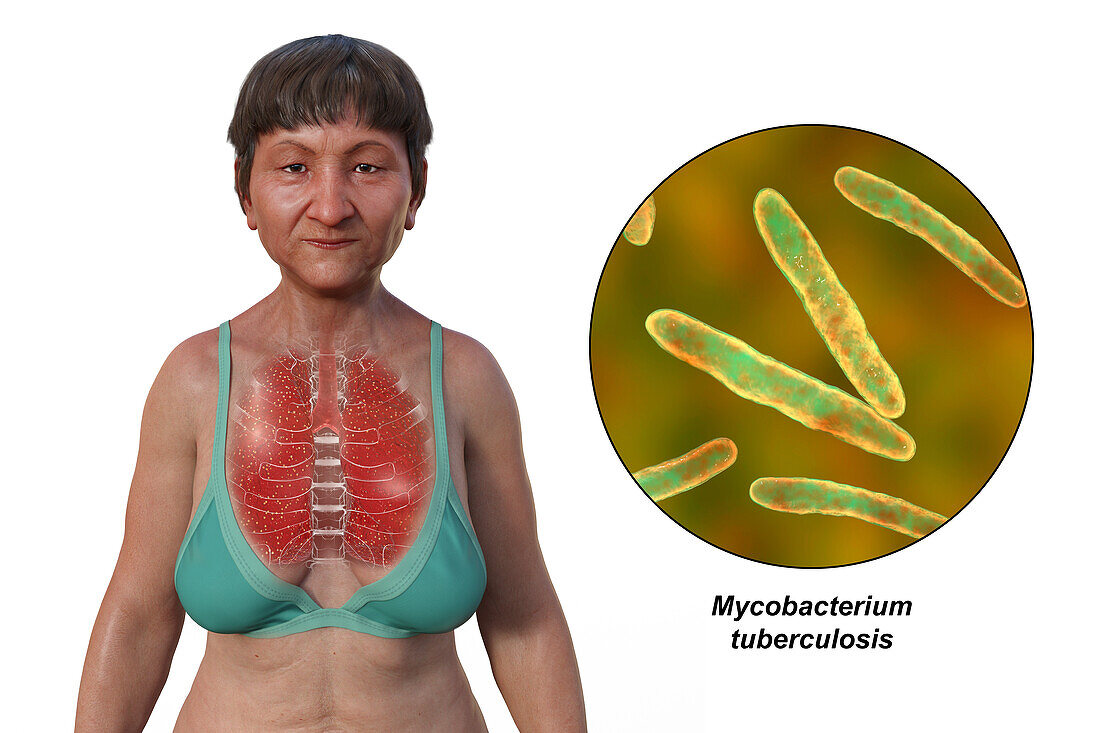 Miliary tuberculosis, illustration