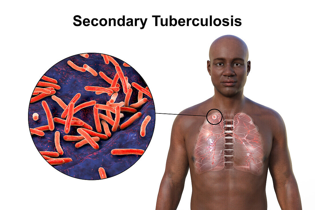 Apical tuberculosis, illustration