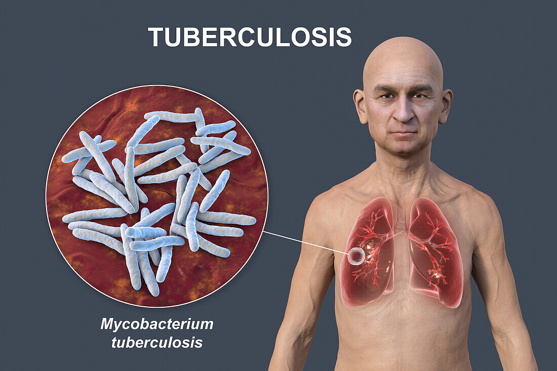 Cavernous tuberculosis, illustration