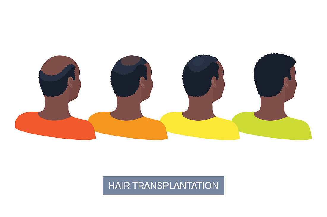 Hair transplantation surgery, conceptual illustration