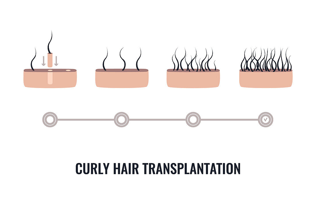 Curly hair transplantation, illustration