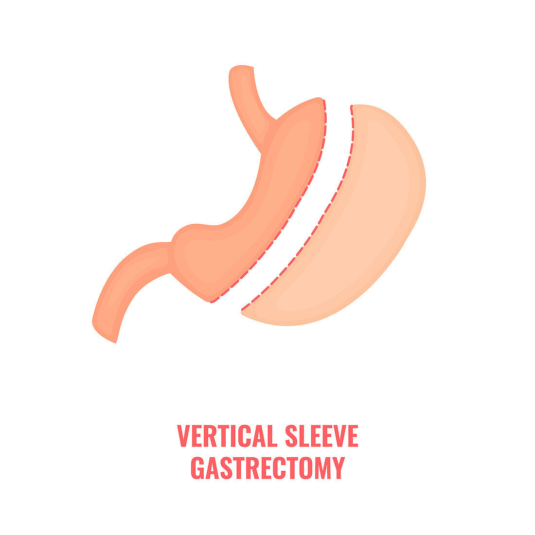 Vertical sleeve gastrectomy, illustration