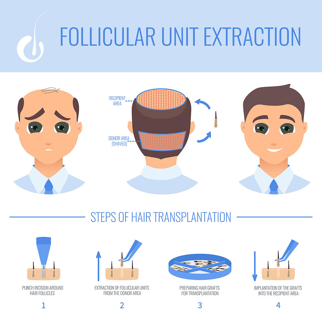 Male hair loss FUE treatment, illustration