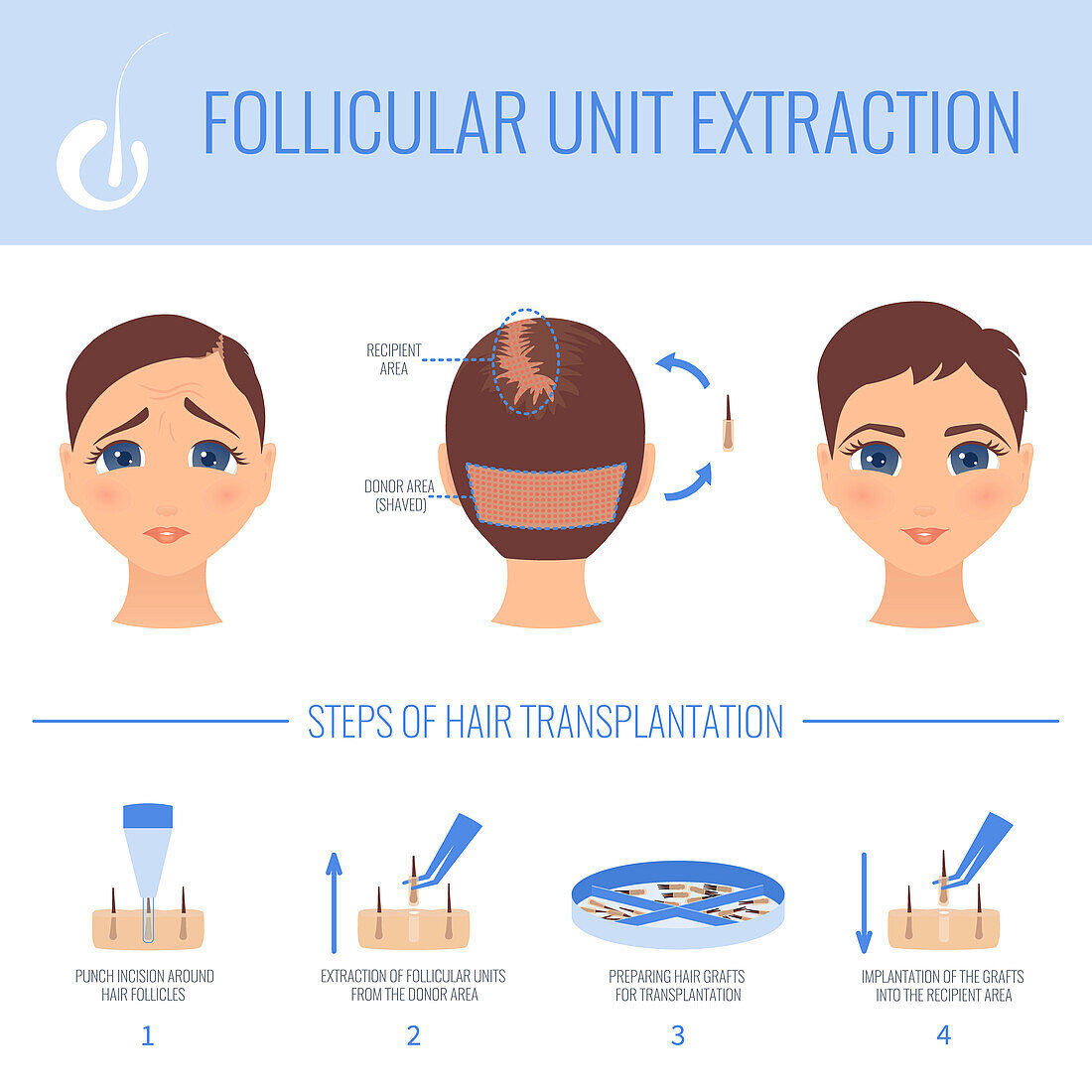 Female hair loss FUE treatment, illustration