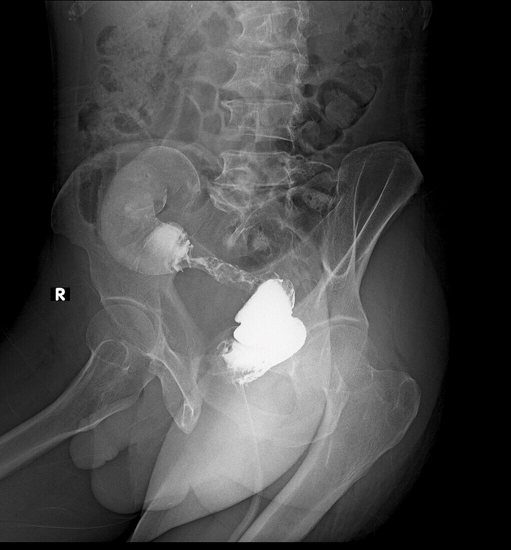 Colorectal cancer, X-ray
