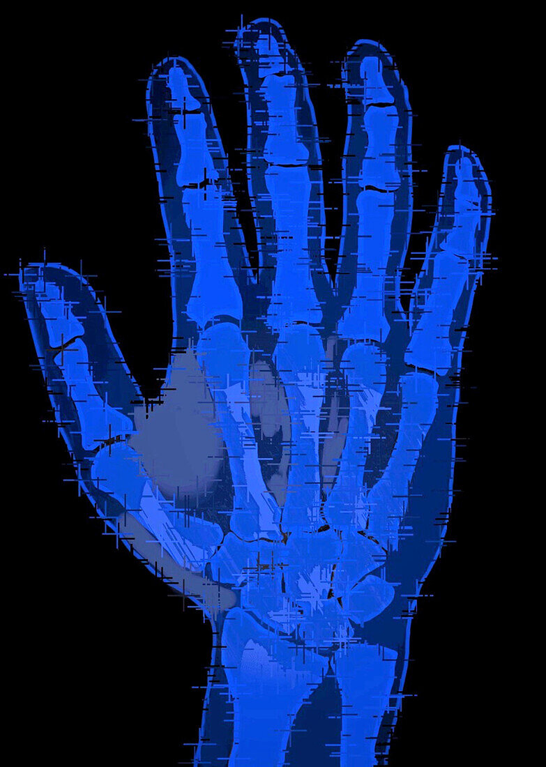 Healthy hand, X-ray