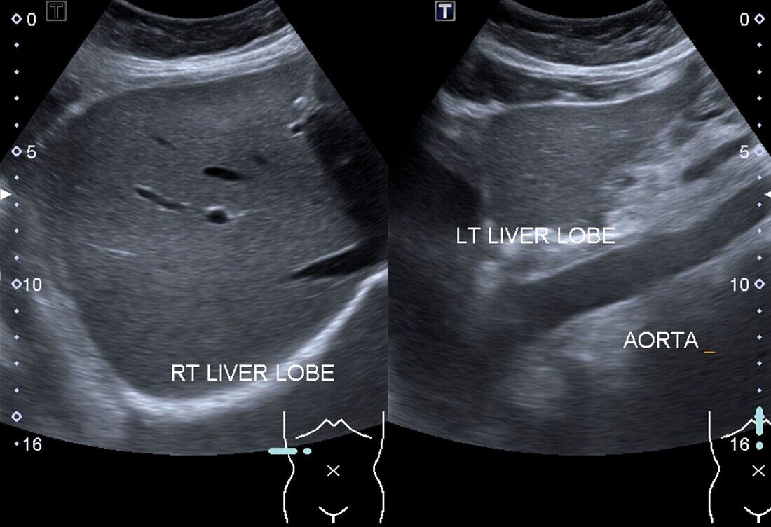Healthy liver, ultrasound scan