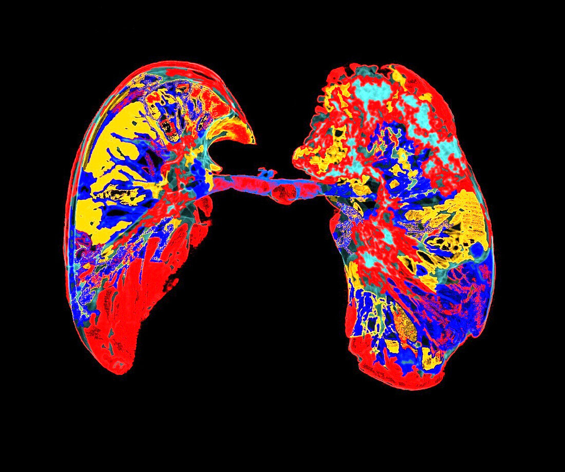 Healthy lungs, CT scan