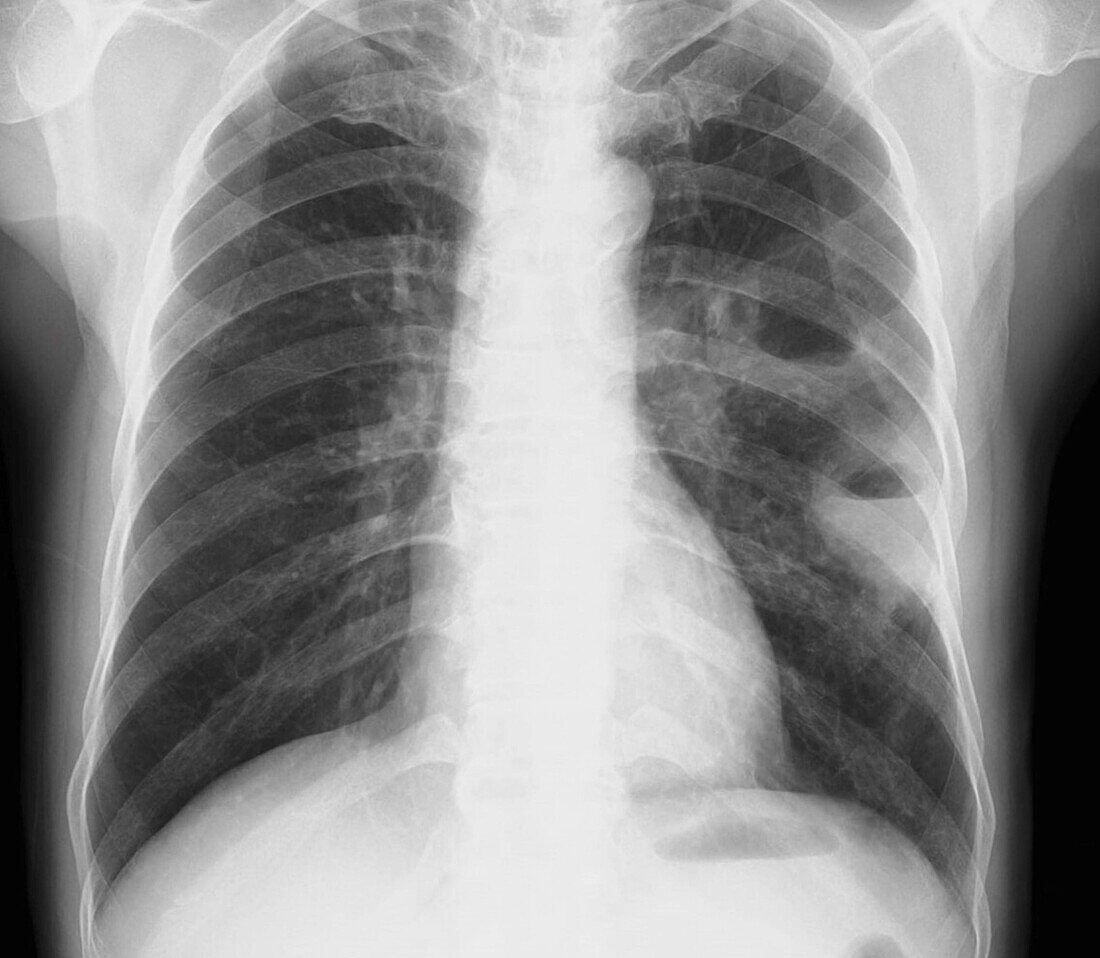 Lung abscesses, X-ray