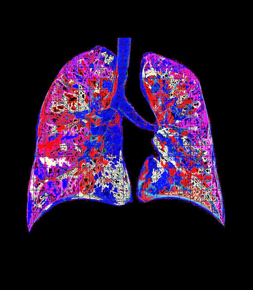 Healthy lungs, CT scan