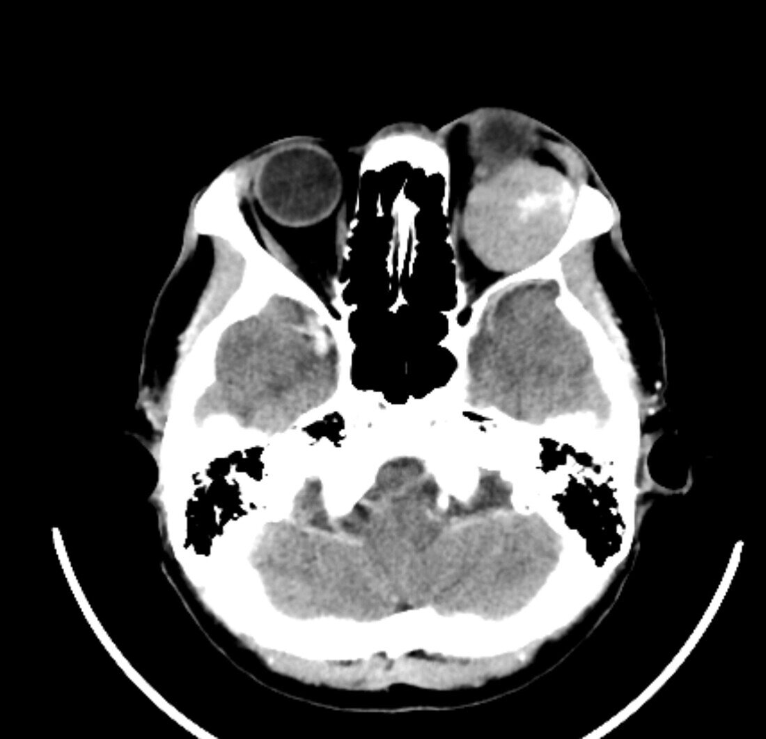 Orbital tumour, CT scan