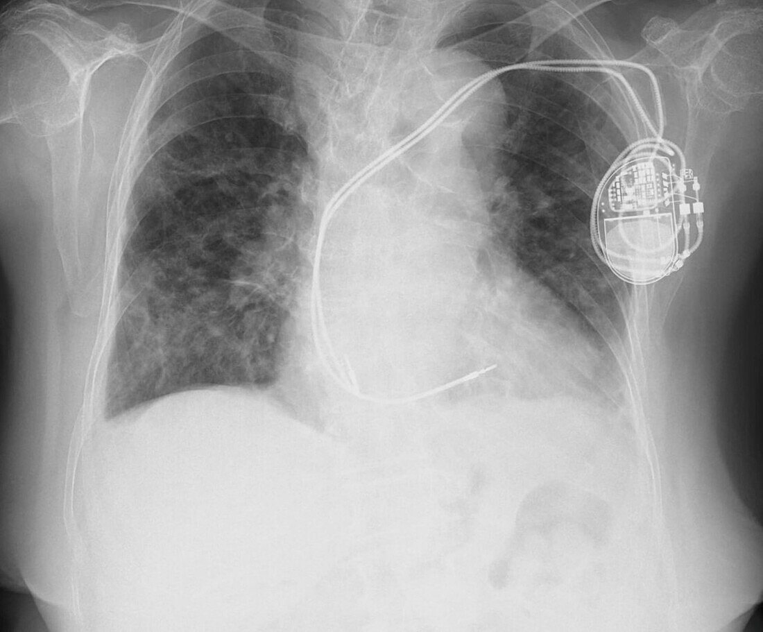 Pacemaker, X-ray