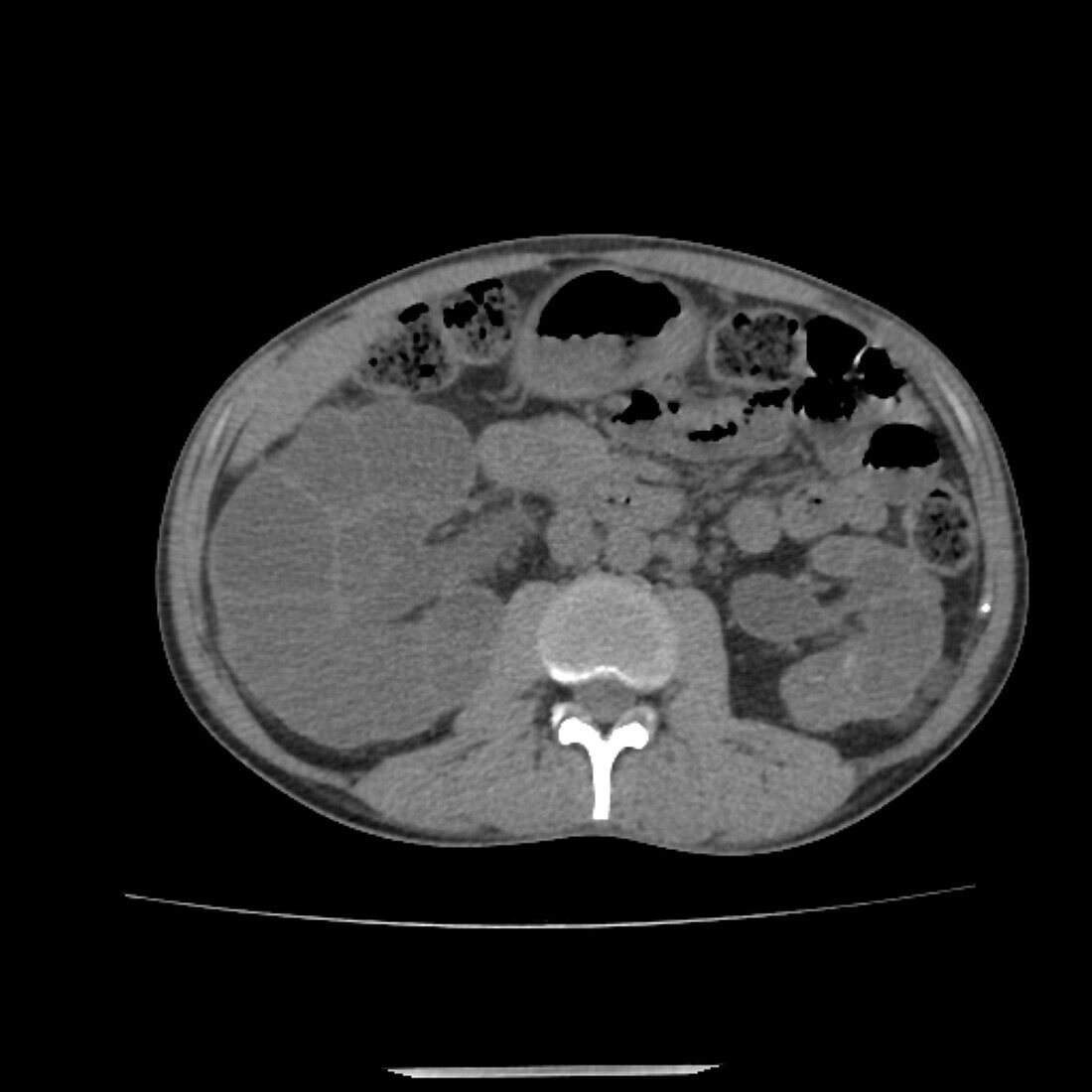 Polycystic kidney disease, CT scan