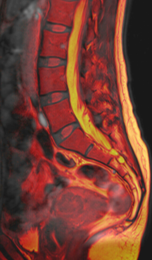 Healthy lower spine, MRI scan