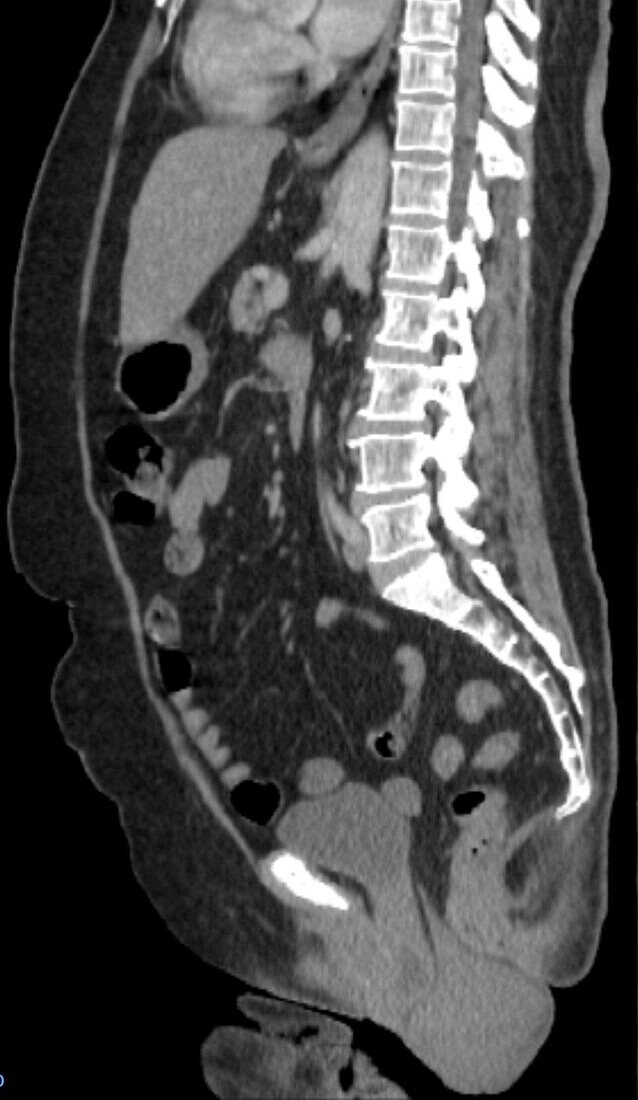 Prolapsed uterus, CT scan