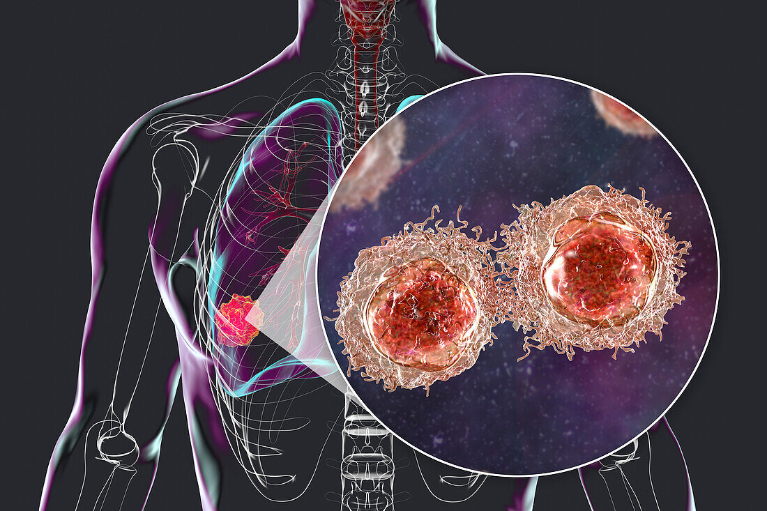 Lung cancer tumour and malignant cells, illustration