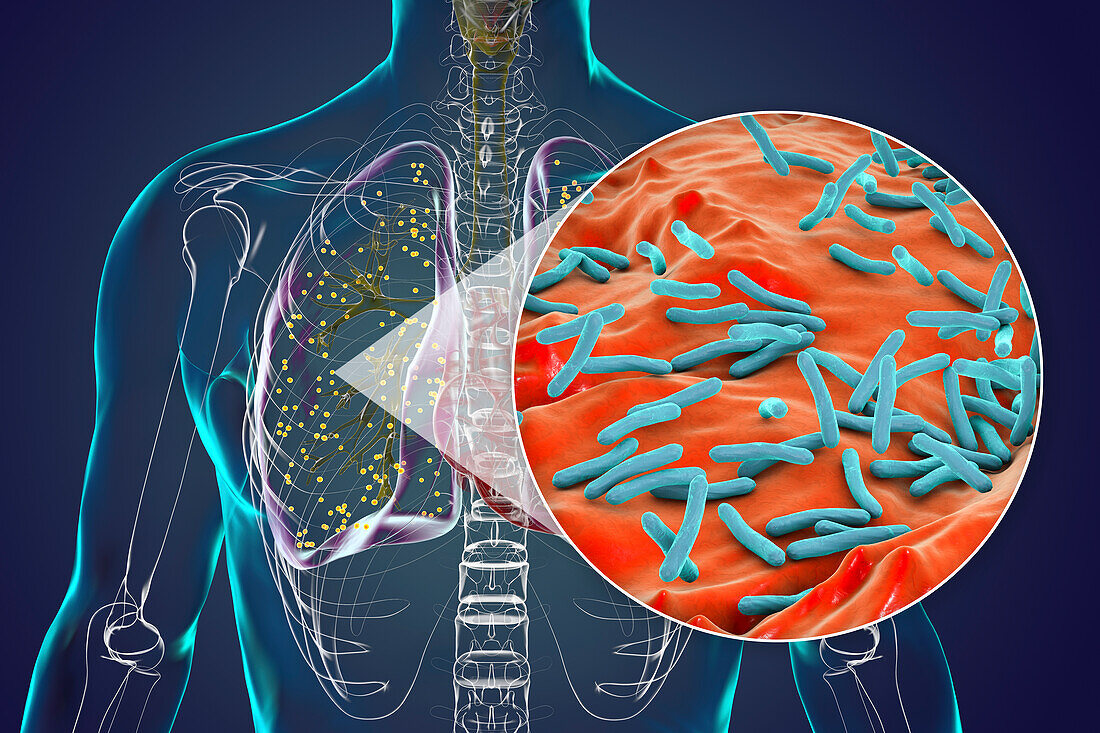 Lungs affected by miliary tuberculosis, illustration