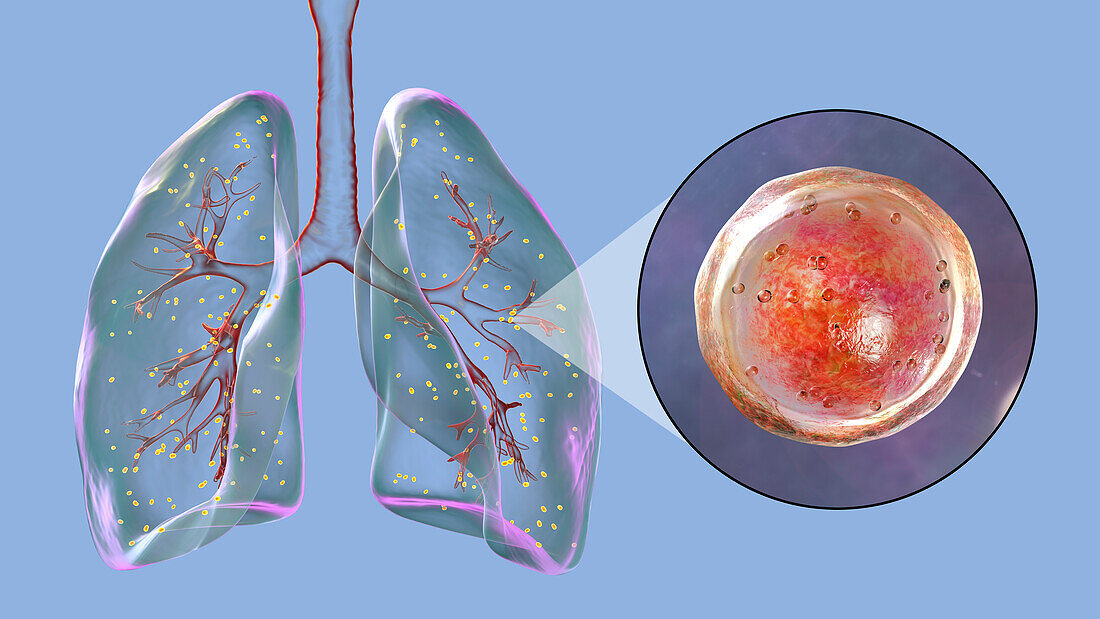 Lung adiaspiromycosis, illustration