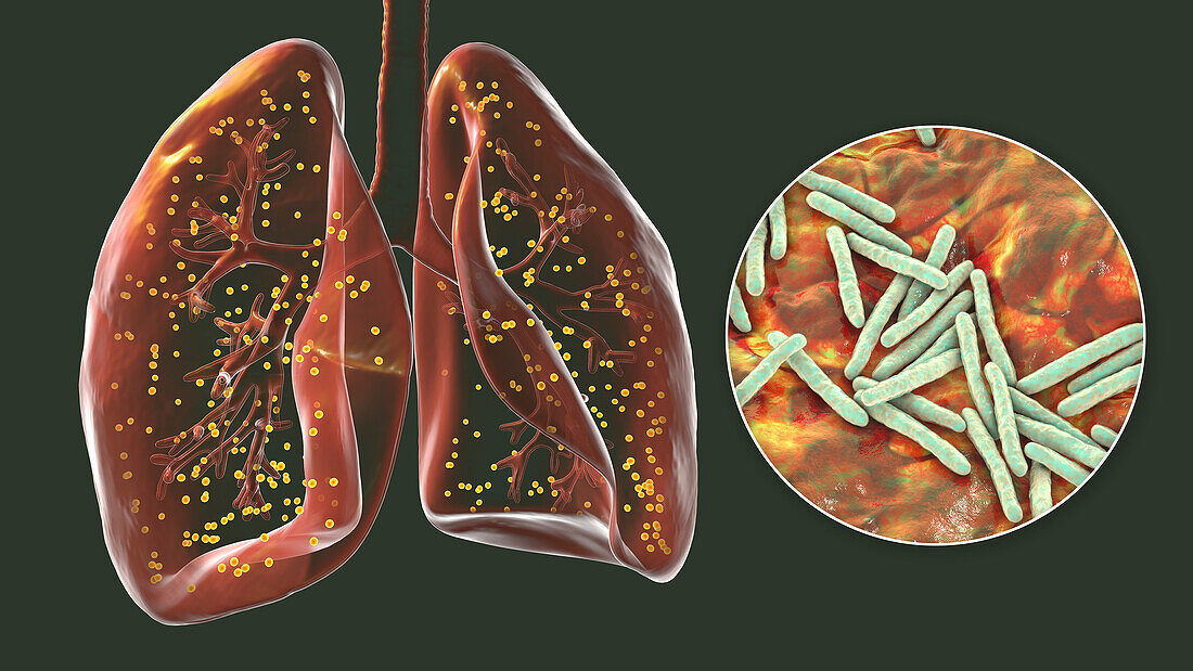 Lungs affected by miliary tuberculosis, illustration
