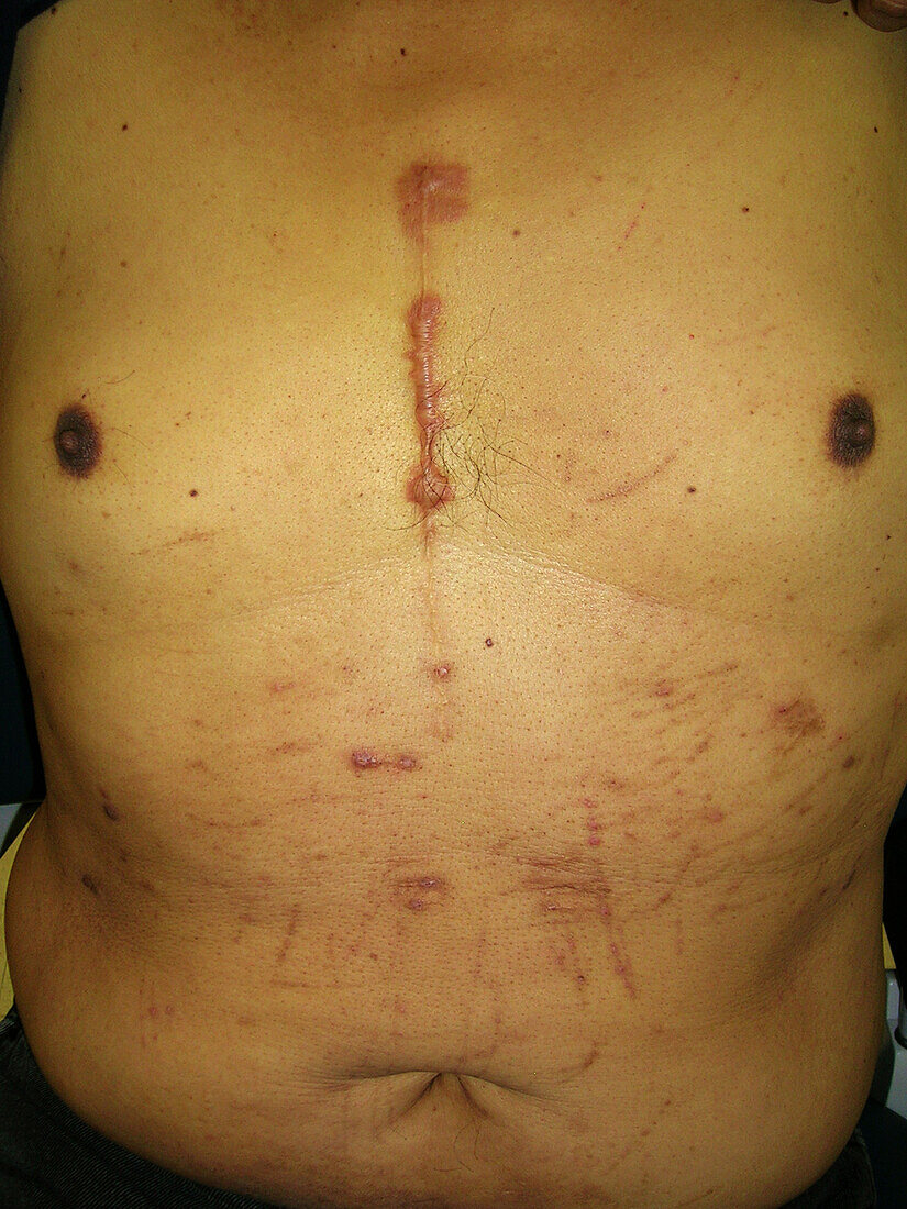 Scratches in patient with jaundice