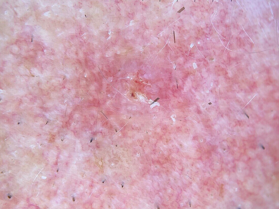 Squamous cell carcinoma, dermoscopy