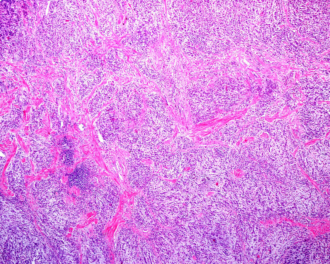 Pleomorphic adenoma in submaxillary gland, light micrograph