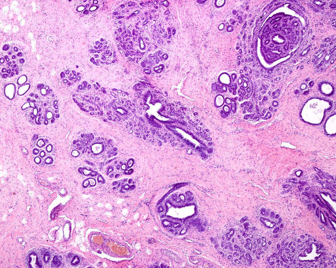 Breast adenosis, light micrograph