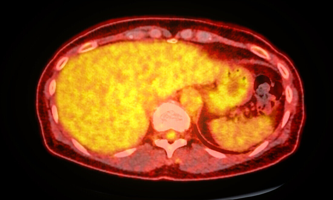 Healthy abdomen, CT-PET scan