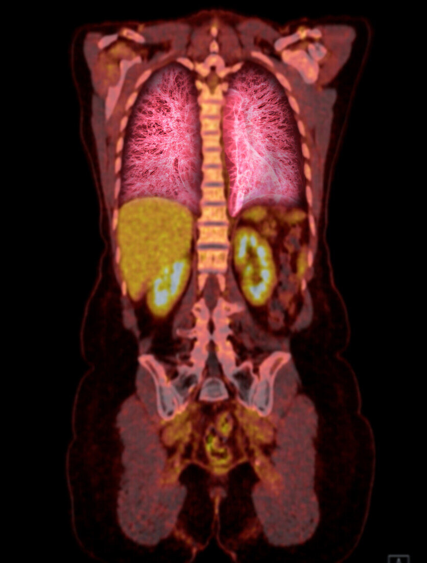 Healthy upper body, CT-PET scan