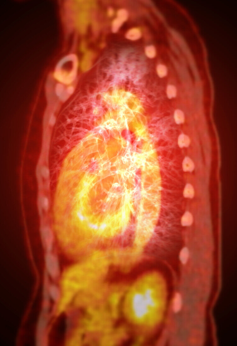 Healthy chest, CT-PET scan