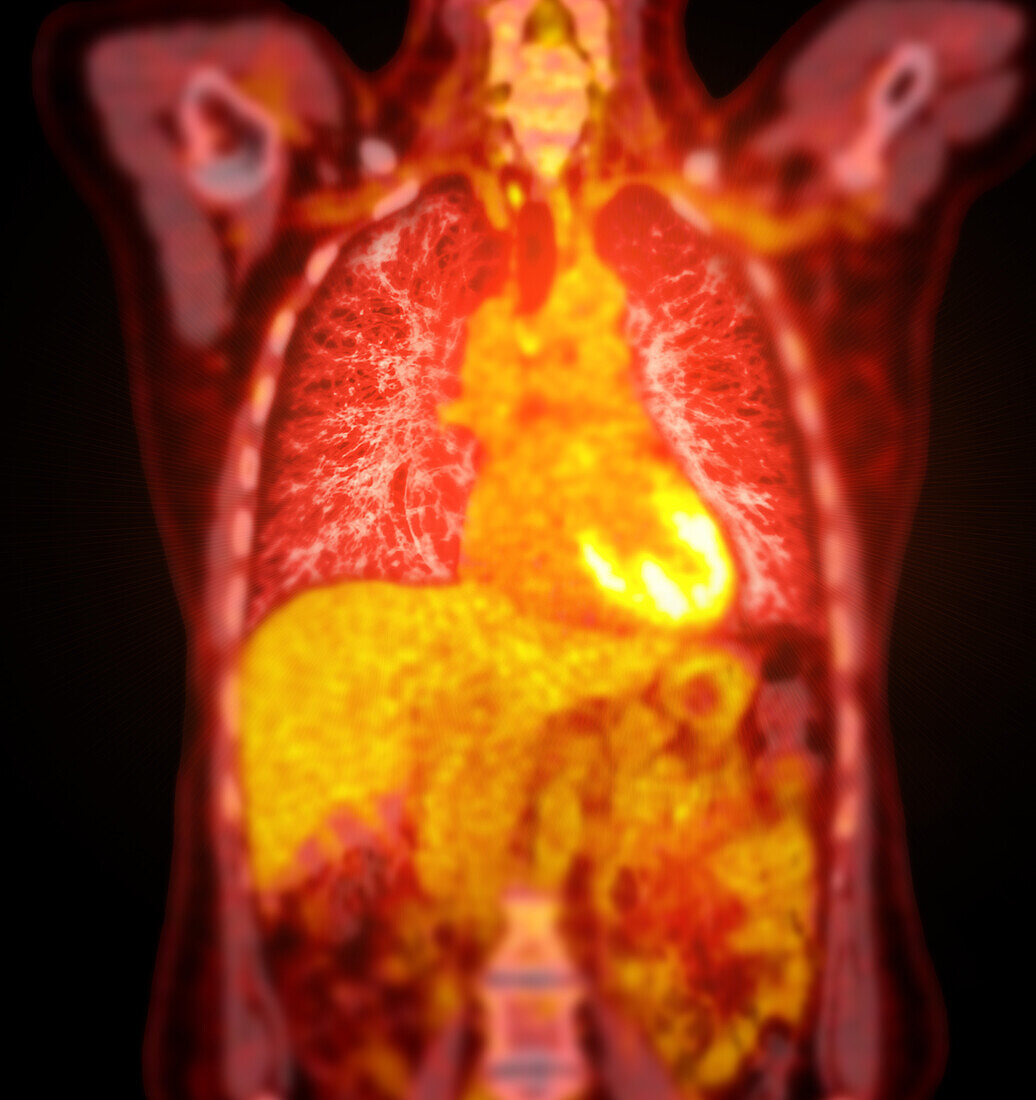 Healthy chest, CT-PET scan