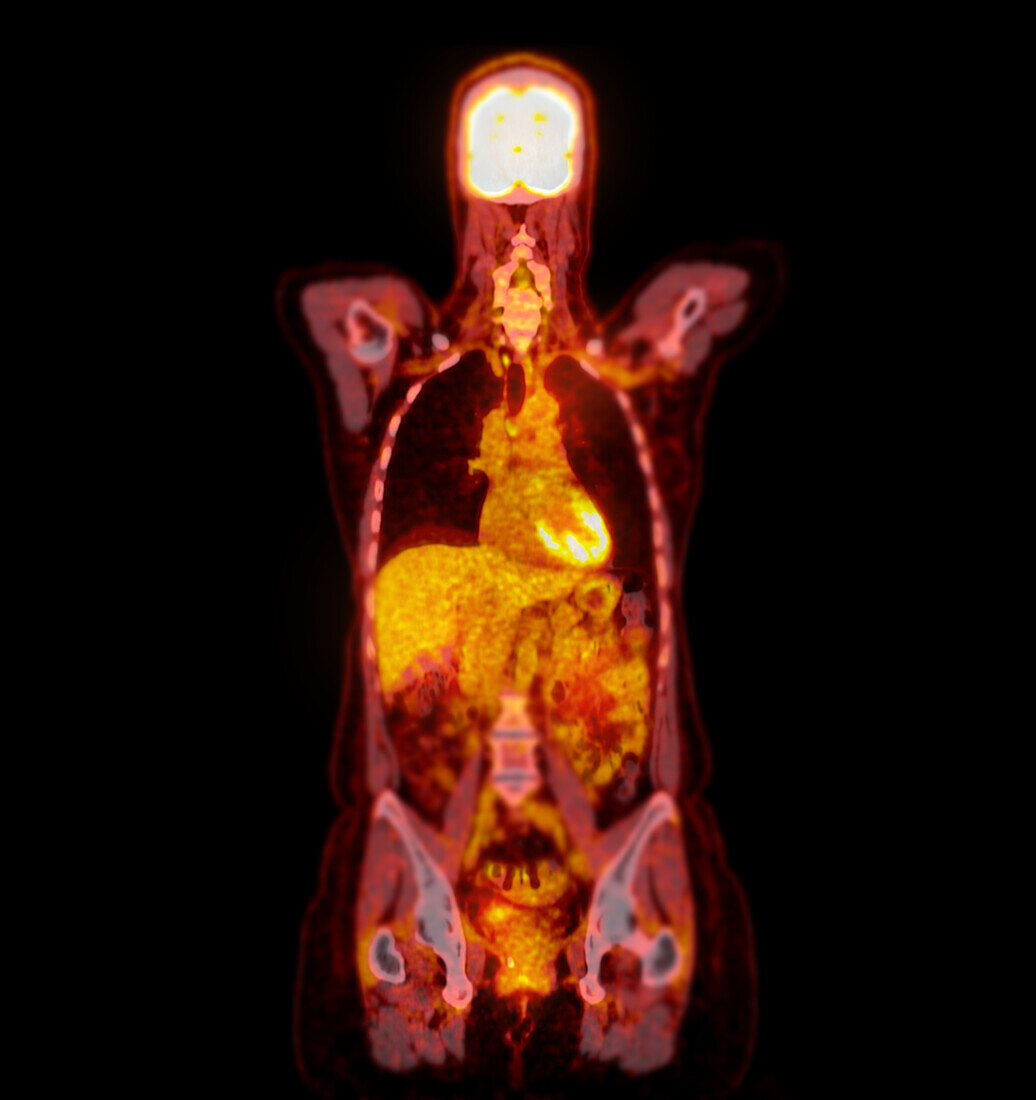 Healthy trunk, CT-PET scan