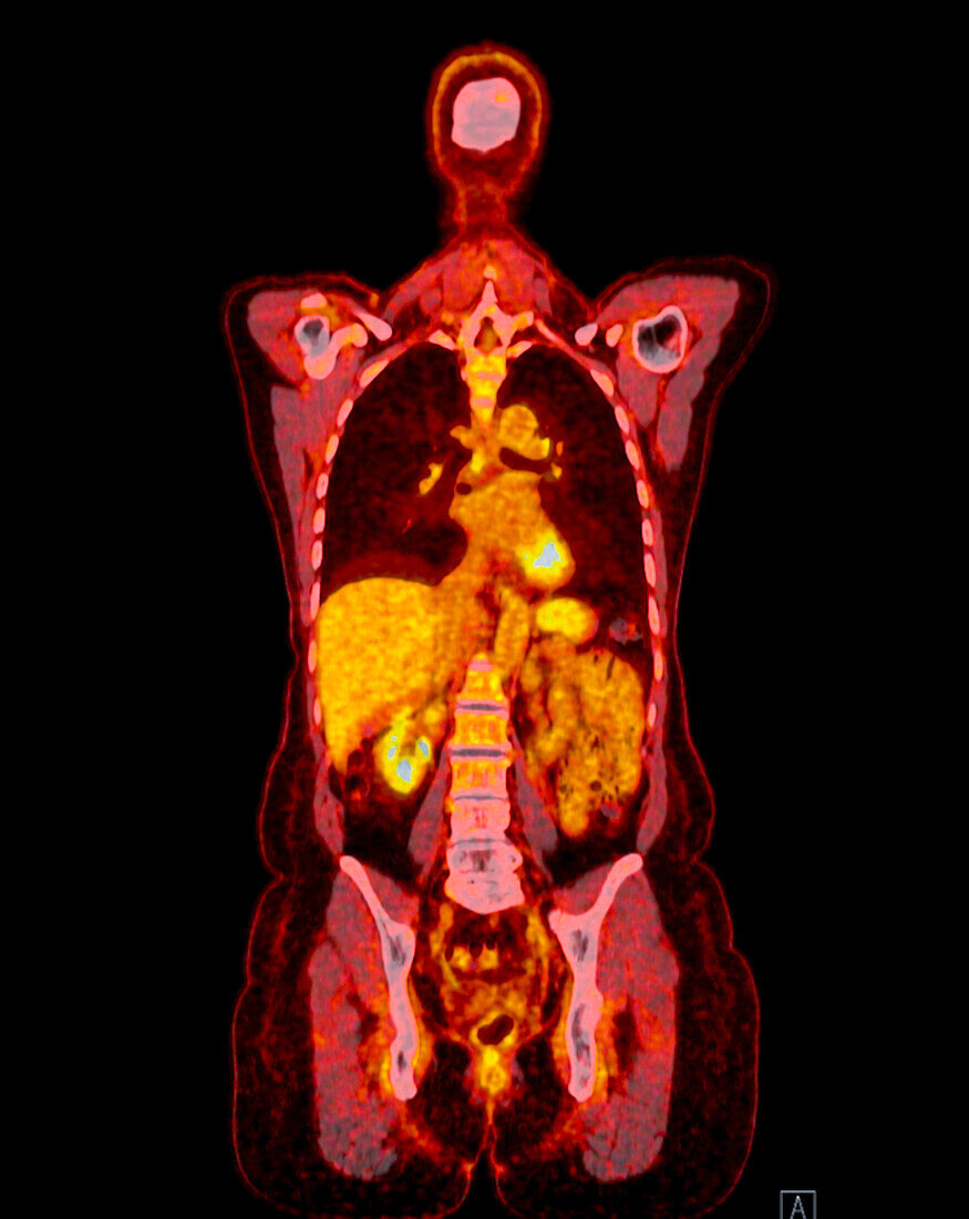 Healthy upper body, CT-PET scan