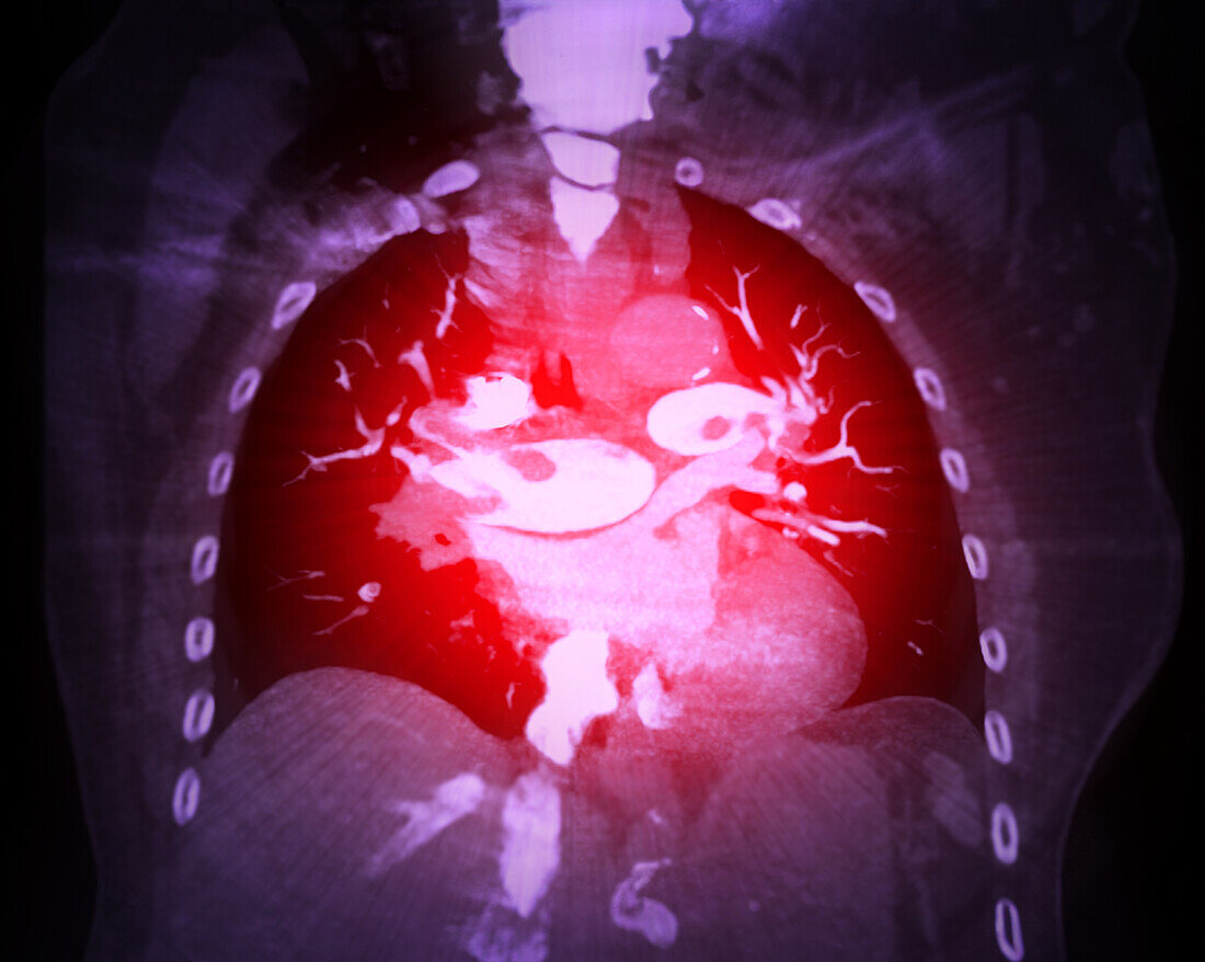 Pulmonary embolism, CT scan