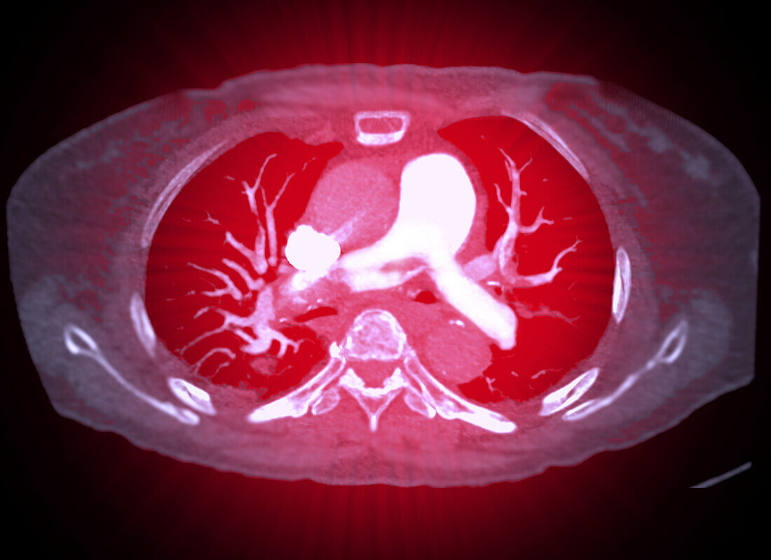 Pulmonary embolism, CT scan