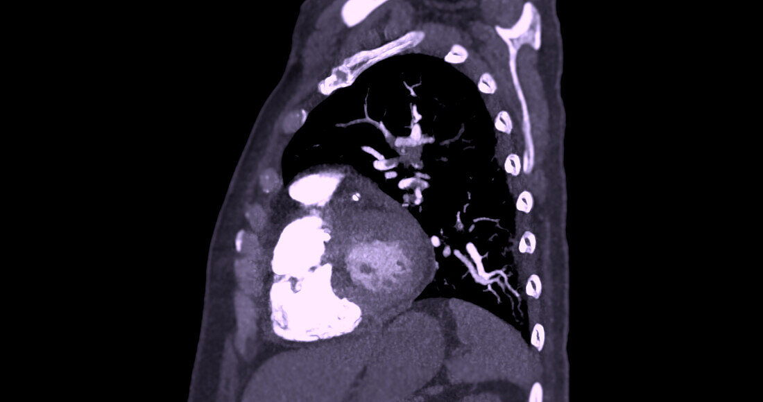 Pulmonary embolism, CT scan