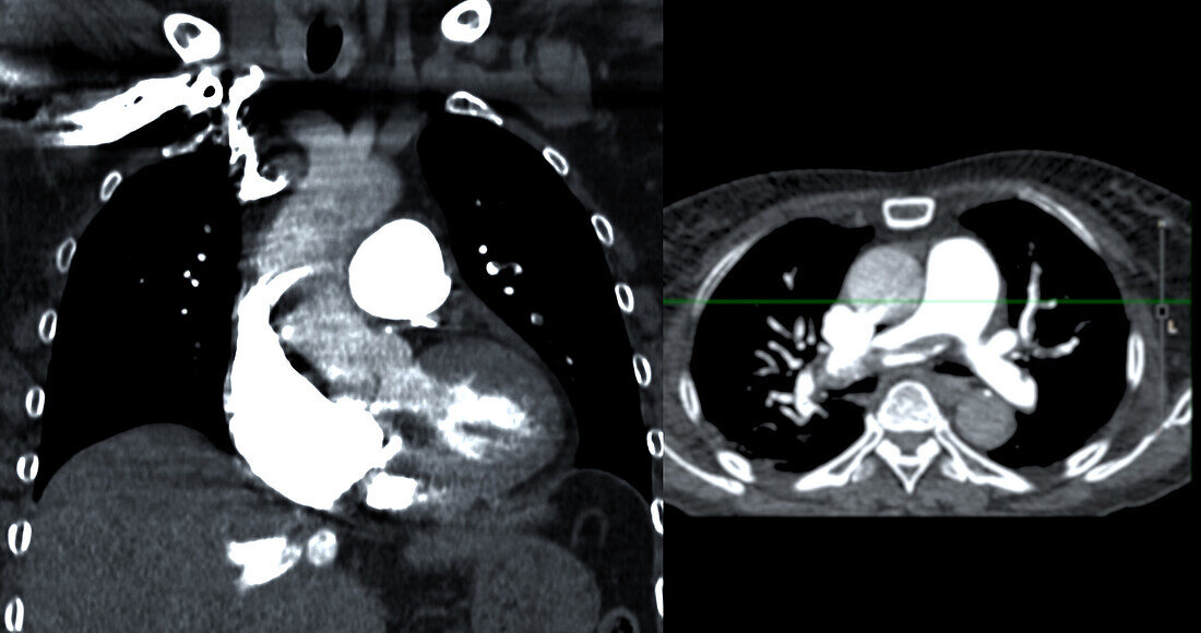 Pulmonary embolism, CT scans